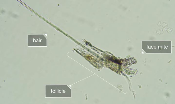 demodex