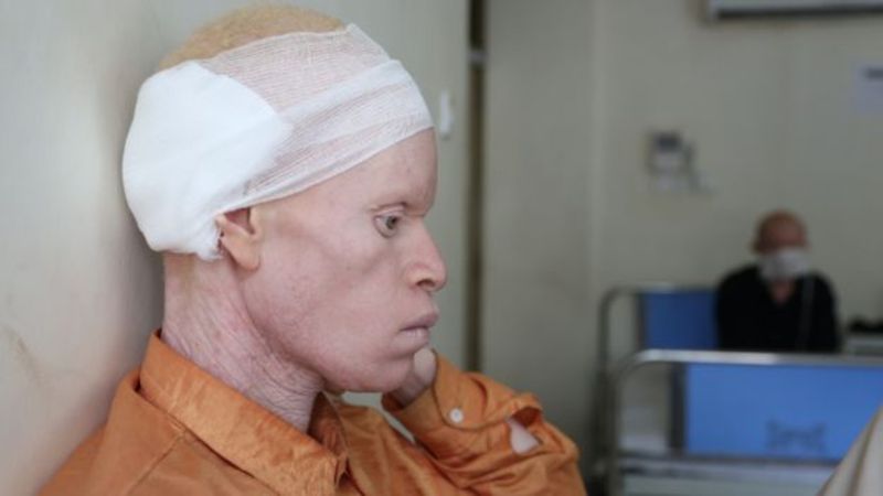 El mayor asesino de albinos es el cáncer de piel. En África la mayoría de los albinos mueren entre los 30 y 40 años.