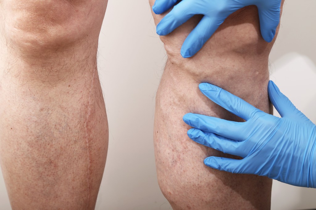 Las estadísticas muestran que cuatro mujeres por cada hombre sufren de venas varicosas.