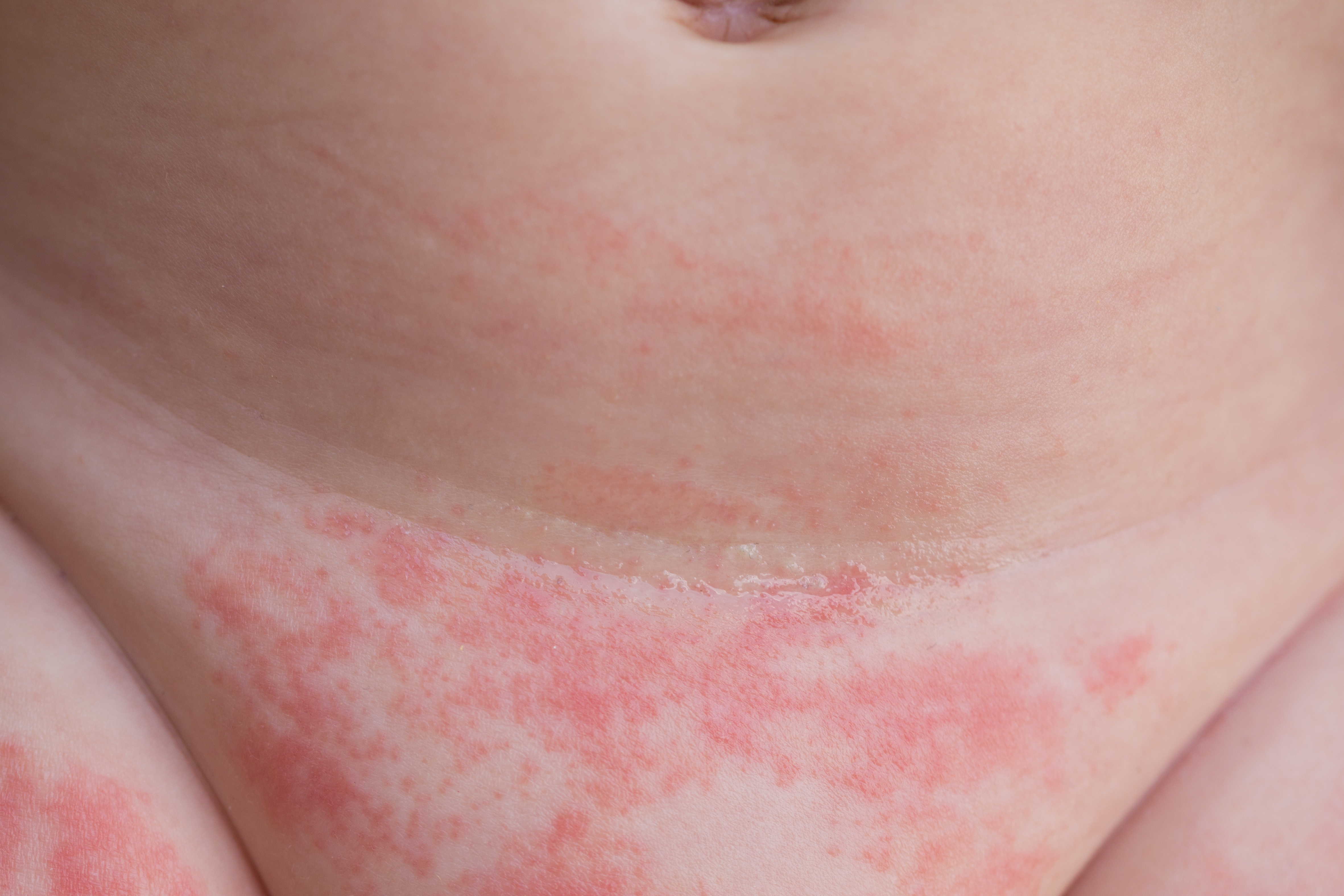 dermatitis pañal